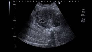 Mini Large subchorionic hematoma [upl. by Ilamad]