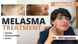 Melasma Treatment Melasma Treatment cream Melasma treatment laser Melasma treatment in Hindi [upl. by Nnaillij575]