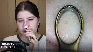 BlackheadRemoving Loop Has BuiltIn Microscope  The Zit Fix  Beauty Insider [upl. by Hanser624]