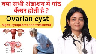 क्या सभी अंडाशय में गांठ कैंसर होती है  Ovarian cyst signs symptoms and treatment [upl. by Nwahsav]