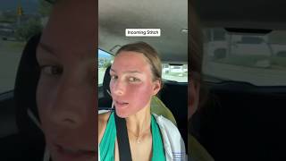 Microneedling on Acne Scars shorts [upl. by Staw270]