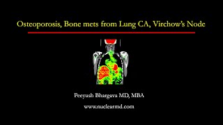 Osteoporosis Bone mets from Lung CA Virchows Node [upl. by Ubald104]