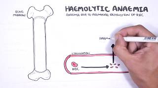 Haemolytic Anaemia  classification intravascular extravascular pathophysiology investigations [upl. by Essilem]