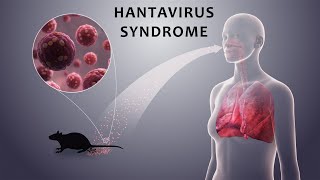 Hantavirus Syndrome [upl. by Annoyik]