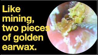 Like mining two pieces of golden earwaxear wax removal  ear cleaning  ASMR  relaxation  relax [upl. by Htrahddis]