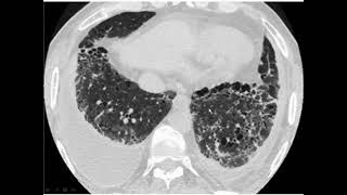 Desquamative interstitial pneumonia [upl. by Fraser]