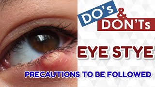 Do and donts in stye eye infection effective home remedies to stop stye infection [upl. by Tcideneb]