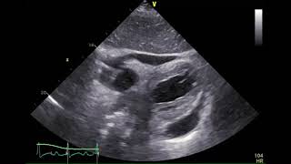 経胸壁心エコー図 心タンポナーデ 2 心窩部四腔像 [upl. by Ardnoed]
