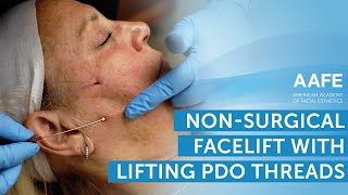 NonSurgical Facelift with Lifting PDO Threads  AAFE [upl. by Surbeck]