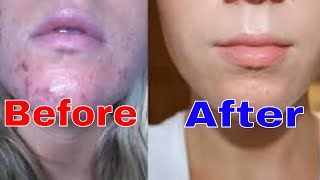 Face Marks Removal  Contractubex Gel How to Use  Scar Treatment on Face  Dr Ali Usman [upl. by Lyrrehs]