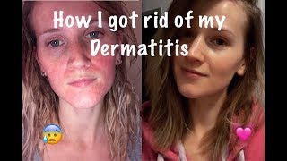 How I Cured My Perioral Dermatitis [upl. by Hnim]