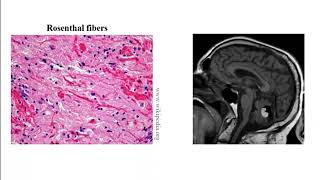 USMLE ACE Video 200 Classification and Pathophysiology of Common Adult and Pediatric Brain Tumors [upl. by Combe236]