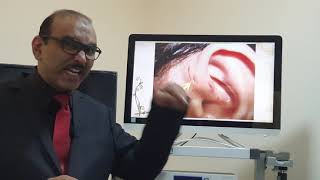 Preauricular sinus Malayalam Patient teaching programme [upl. by Aderf493]