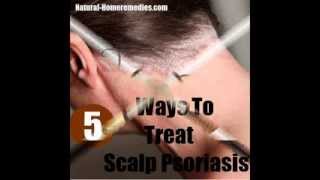 Best Scalp Psoriasis Treatment [upl. by Jordanna]