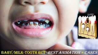 Cavity Root Canal Treatment in Kids Pulpectomy Best Animation of RCT in MilkBabyPrimary Teeth [upl. by Dinerman]