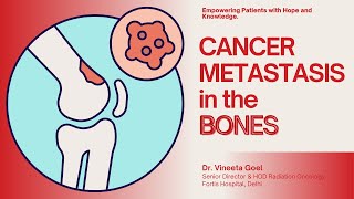 Cancer metastasis in the bones हड्डी के कैंसर के इलाज के बारे में जाने [upl. by Thibault]