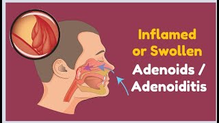 Inflamed or Swollen Adenoids  Adenoiditis [upl. by Heinrich45]