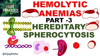 Hemolytic Anemias Part 3 HEREDITARY SPHEROCYTOSIS [upl. by Nelrah]