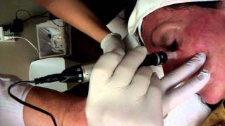 Dermapen Under The Eye Treatment  Micro Skin Needling [upl. by Anes]