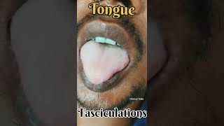 Tongue Fasciculations fasciculation snakebite neurotoxin clinicaltalks [upl. by Tnahs]