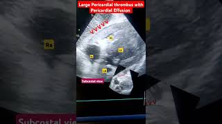 ख़ून का बड़ा थका हार्ट के ऊपर l Large thrombus in Pericardial cavity echo shorts [upl. by Eelannej]