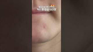 좁쌀 여드름 흔적없이 피부가 깨끗한 이유✨  올리브영 트러블 패치 추천템 좁쌀패치 [upl. by Travis]