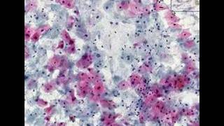 Histopathology Cervix  High grade squamous intraepithelial [upl. by Dyane]