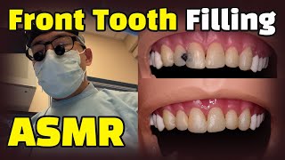 How to fix cavities between front teeth  Dental ASMR Composite Resin Filling Procedure Explained [upl. by Vish133]