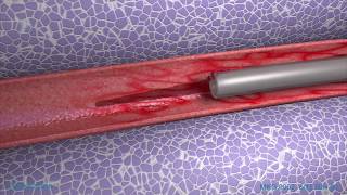 Peripheral IV Phlebitis Animation [upl. by Swayne]