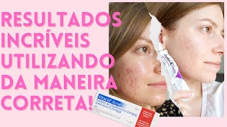 VITACID ACNE Como usar efeitos colaterais funciona Clindamicina  Tretinoína  ACNE E MANCHAS 💦 [upl. by Larrie]