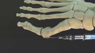 bunion surgery 3D [upl. by Clyte]