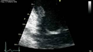 RUPTURE CHORDAE POSTEROMEDIAL PAPILARY MUSCLE  MR PROLAPSE [upl. by Hecht686]