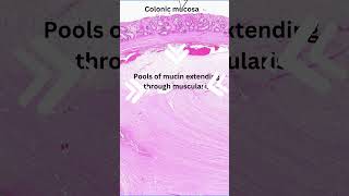 Histology of colitis cystica profunda [upl. by Lehcin538]