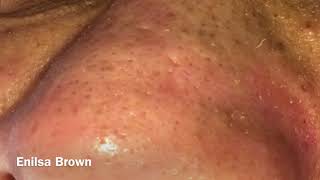 Blackheads Extractions and Acne Treatment on Daryl [upl. by Jammal299]