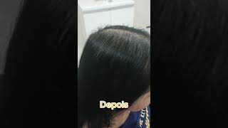 Alopecia Androgenética Antes e DepoisVejam Esse Antes e Depois Surpreendente LINK ABAIXO shorts [upl. by Gianni]