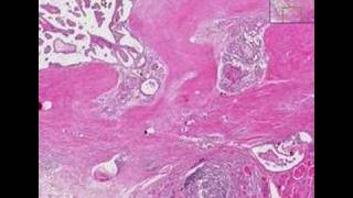 Histopathology ThyroidHashimoto thyroiditis papillary car [upl. by Caasi]