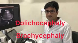 Sonography Dolichocephaly and Brachycephaly [upl. by Attlee]