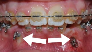 HOW BRACES WORK  FOUR Impacted CANINES in a 👧 [upl. by Iinden103]