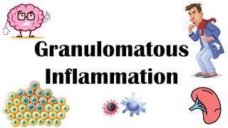 Granulomatous Inflammation  Types Pathophysiology Different Cell Types In Granuloma amp Examples [upl. by Anglo]