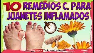 COMO ELIMINAR LOS JUANETES con Estos 10 Remedios Caseros Para los JUANETES INFLAMADOS [upl. by Feetal485]