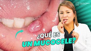 Descubre todo sobre el tratamiento de Mucocele [upl. by Slinkman]