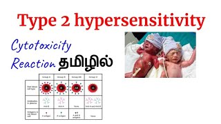 Type 2 hypersensitivity reaction in tamil [upl. by Lillywhite]